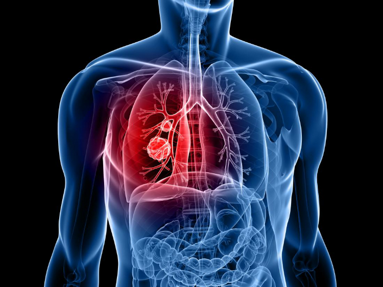 Desconhecimento sobre o cancro do pulmão atrasam diagnósticos